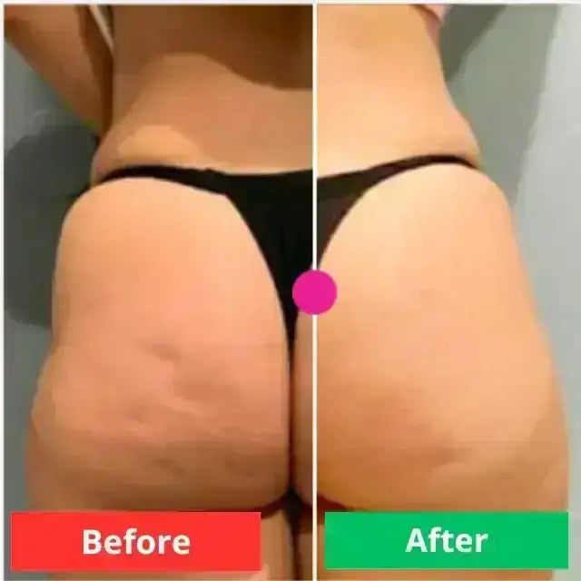 Adeus Para Celulitis y Estrias